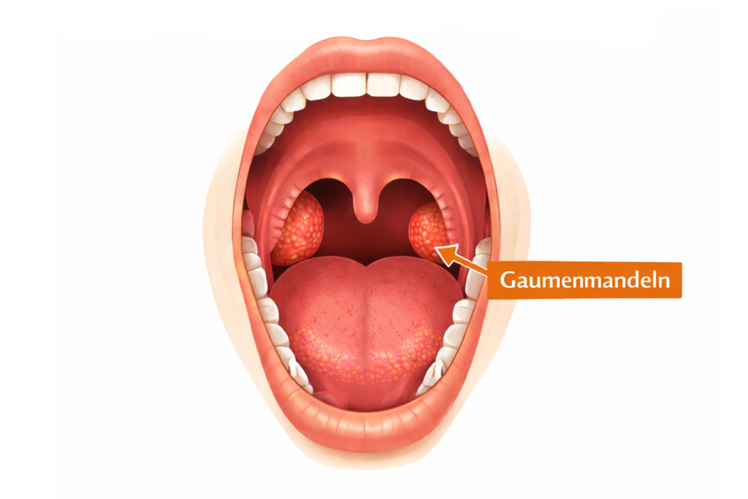 Die Gaumenmandeln im Rachenraum